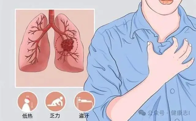 咳白痰是肺癌_咳嗽白痰肺癌_咳嗽白痰肺癌