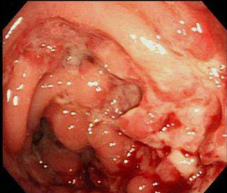 克罗恩病让这群年轻人痛不欲生_克罗恩病让这群年轻人痛不欲生_克罗恩病让这群年轻人痛不欲生