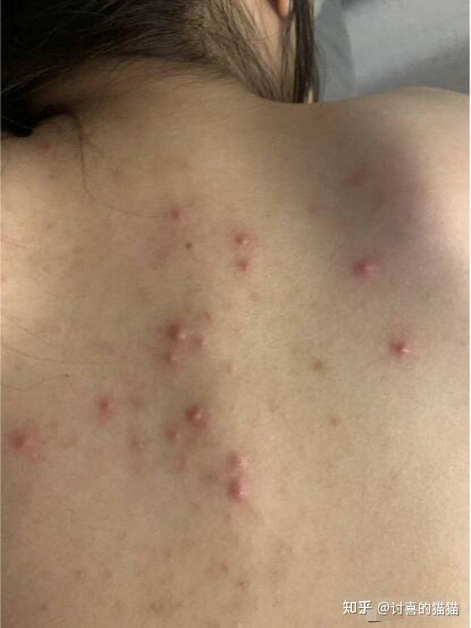 安贞医院皮肤科：痘痘的克星，温暖的港湾