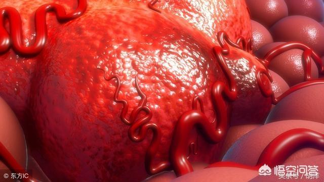 铁蛋白 肺癌_肺癌铁蛋白高是怎么回事_早期肺癌会引起铁蛋白高300