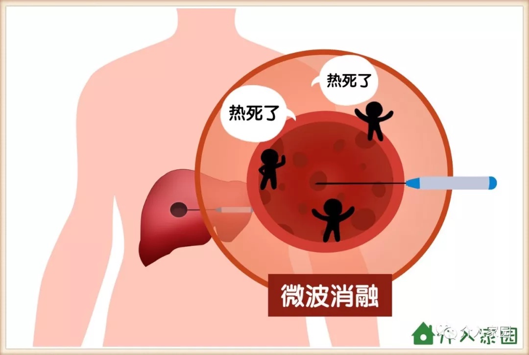 铁蛋白 肺癌_早期肺癌会引起铁蛋白高300_肺癌铁蛋白高是怎么回事