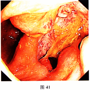 回盲部腺样征：复杂名称背后的肠道小问题，你了解多少？