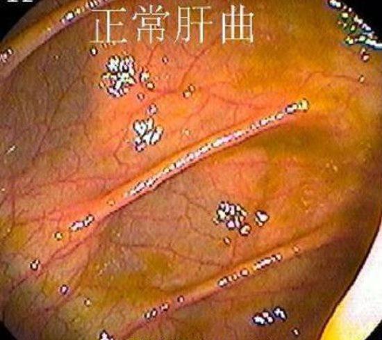 回盲部腺样征_回盲部腺体增生_回盲部腺瘤样增生