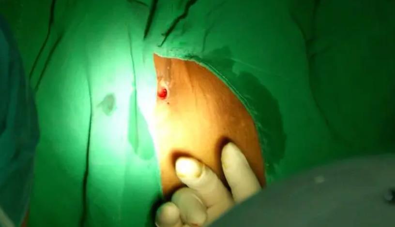 手术恢复肛瘘时间多久_肛瘘手术恢复时间_手术恢复肛瘘时间多长