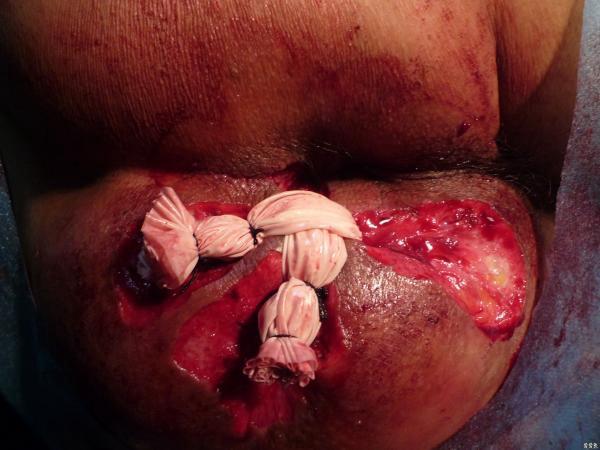 肛瘘手术时间多久-肛瘘手术：时间虽短，煎熬却长，准备与恢复全攻略