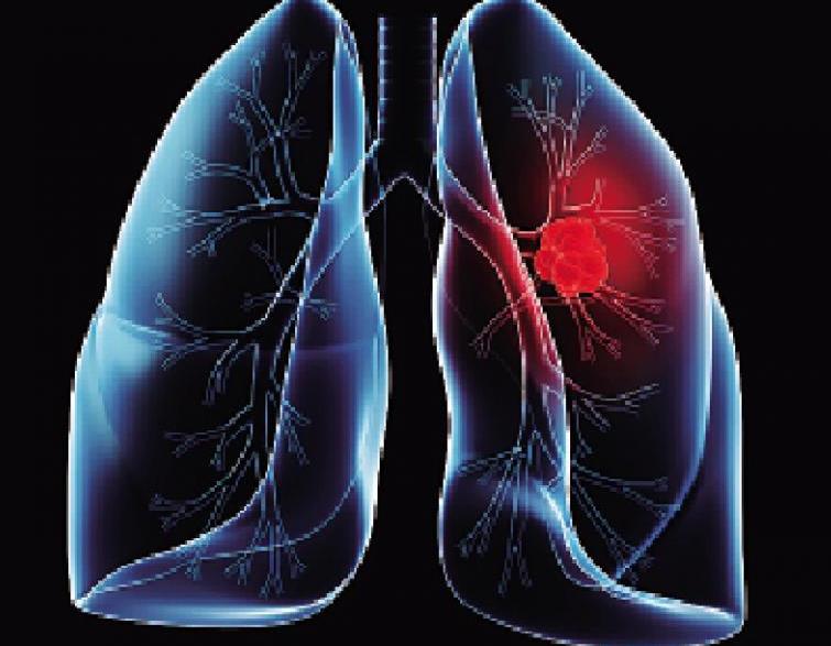 肺结核严重症状有哪些表现_肺结核严重吗会死人吗_肺结核严重吗?